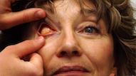 Visit: Eye Surgery